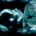 Sonograms